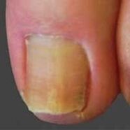 infección das unhas por dermatofitos