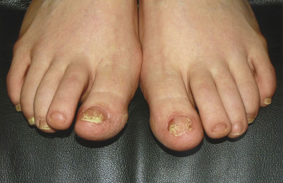 como tratar o fungo das unhas do pé con esmalte
