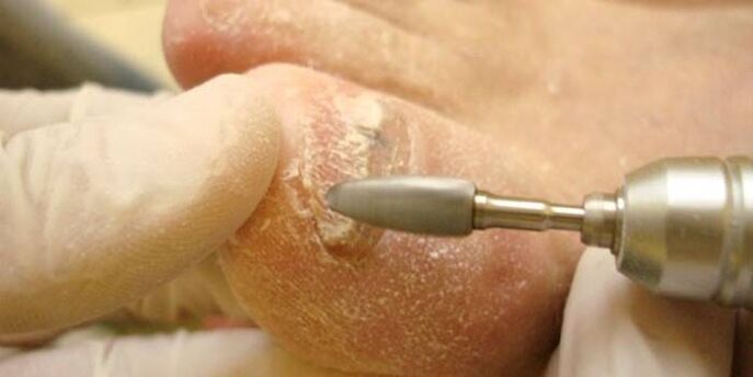 eliminación de unhas por fungos