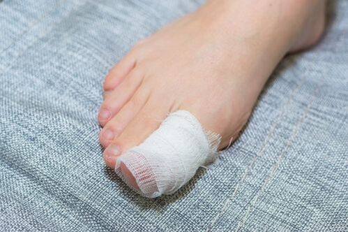 Loción de vinagre de mazá para fungos nas unhas