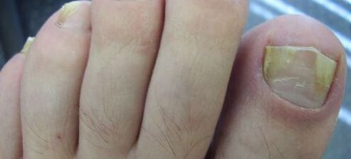 síntomas de fungo na unha e o seu tratamento con vinagre