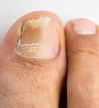 Fungo da unha no dedo gordo do pé, que ocorre no contexto dunha inmunidade débil