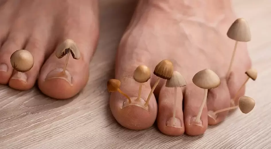 Infección fúngica que afecta ás uñas dos pés