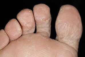 A pel dos pés cunha infección fúngica