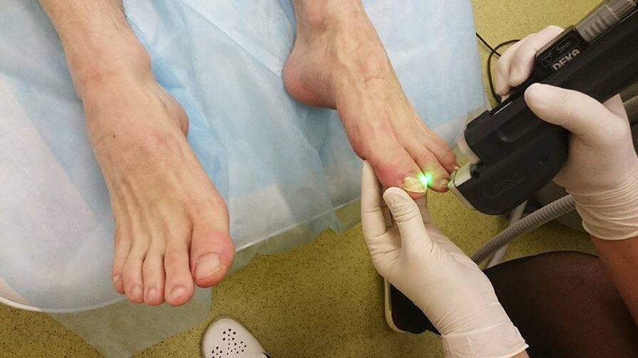 Tratamento con láser para fungos nas unhas dos pés