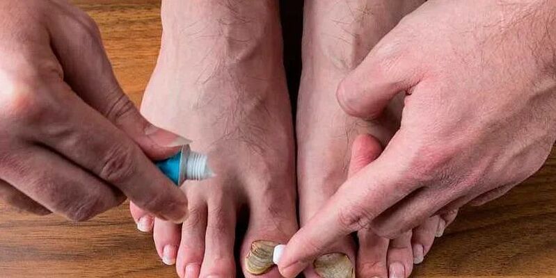 causas de fungo entre os dedos dos pés
