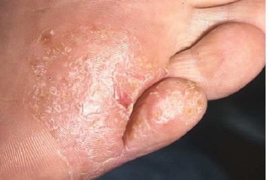 Manifestacións dunha infección fúngica na pel do pé