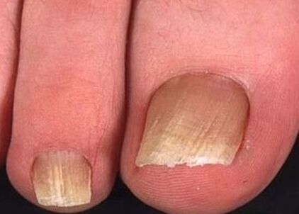 Fungo das uñas nas pernas da fase inicial