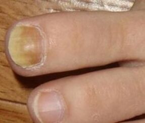 Síntomas da etapa inicial do fungo das uñas